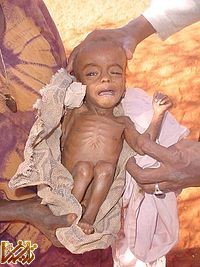 https://enikazemi.ir/images/2011/08/200px-Malnourished_child_in_Somalia151.jpg